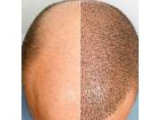 Alpha Aesthetics GmbH | Alpha Hair Center - GALLERY