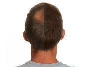 Alpha Aesthetics GmbH | Alpha Hair Center - GALLERY