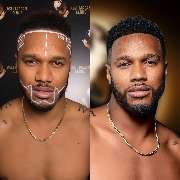 Asli Tarcan Clinic | Haartransplantationen in der Türkei Istanbul - GALLERY