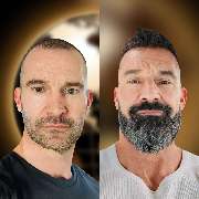 Asli Tarcan Clinic | Haartransplantationen in der Türkei Istanbul - GALLERY