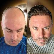 Asli Tarcan Clinic | Haartransplantationen in der Türkei Istanbul - GALLERY