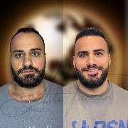 Asli Tarcan Clinic | Haartransplantationen in der Türkei Istanbul - GALLERY