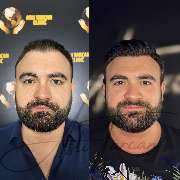 Asli Tarcan Clinic | Haartransplantationen in der Türkei Istanbul - GALLERY