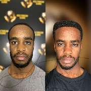 Asli Tarcan Clinic | Haartransplantationen in der Türkei Istanbul - GALLERY