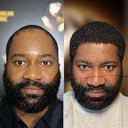 Asli Tarcan Clinic | Haartransplantationen in der Türkei Istanbul - GALLERY