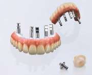 Dentallabor Christian Stroehl - GALLERY
