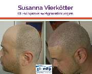 GI-MHP Ultra Nano Haarpigmentierung - Haarpigmentierung Gi mhp -