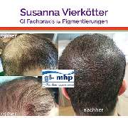 GI-MHP Ultra Nano Haarpigmentierung - Microhaar Verdichtung 21-