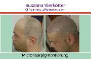 GI-MHP Ultra Nano Haarpigmentierung - MicrohaarPigmentierung