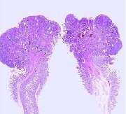 GP für Pathologie & Zytologie Köln Weyertal - Dr. Mellin und Dr. Melzer - Polyp unter dem Mikroskop