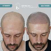 Haarpigmentierung Berlin | OpticHair - GALLERY