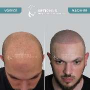 Haarpigmentierung Berlin | OpticHair - Haarpigmentierung Vorher Nachher Bilder Optic Hair