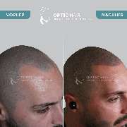 Haarpigmentierung Berlin | OpticHair - Haarpigmentierung Vorher Nachher Bilder Optic Hair