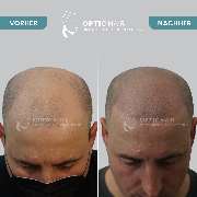 Haarpigmentierung Berlin | OpticHair - Haarpigmentierung Vorher Nachher Bilder Optic Hair