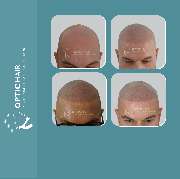 Haarpigmentierung Berlin | OpticHair - Haarpigmentierung Vorher Nachher Bilder Optic Hair