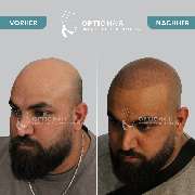 Haarpigmentierung Berlin | OpticHair - Haarpigmentierung Vorher Nachher Bilder Optic Hair