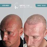 Haarpigmentierung Berlin | OpticHair - Haarpigmentierung Vorher Nachher Bilder Optic Hair