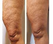 Kryolipolyse Beauty Queen Josys cosmetica - GALLERY