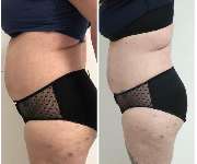 Kryolipolyse Beauty Queen Josys cosmetica - GALLERY