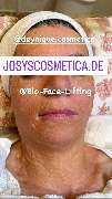 Kryolipolyse Beauty Queen Josys cosmetica - GALLERY