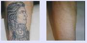 LASER Forum Essen GmbH - Tattooentfernung VN 1.jpg