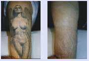 LASER Forum Essen GmbH - Tattooentfernung VN 5.jpg