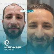 MedHair Clinic | Haartransplantation Türkei - GALLERY