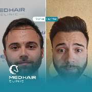 MedHair Clinic | Haartransplantation Türkei - GALLERY