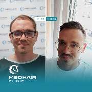 MedHair Clinic | Haartransplantation Türkei - GALLERY
