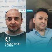 MedHair Clinic | Haartransplantation Türkei - GALLERY