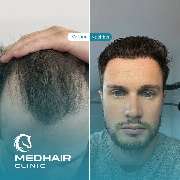 MedHair Clinic | Haartransplantation Türkei - GALLERY
