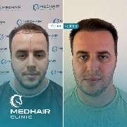 MedHair Clinic | Haartransplantation Türkei - GALLERY