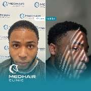 MedHair Clinic | Haartransplantation Türkei - GALLERY