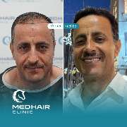 MedHair Clinic | Haartransplantation Türkei - GALLERY