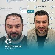 MedHair Clinic | Haartransplantation Türkei - GALLERY