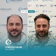 MedHair Clinic | Haartransplantation Türkei - GALLERY