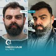 MedHair Clinic | Haartransplantation Türkei - GALLERY