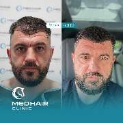 MedHair Clinic | Haartransplantation Türkei - GALLERY
