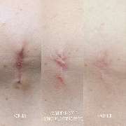 Medichelle Cosmetics - Sara-pavo.cosmetics-Narbe-essen.jpg