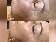 Medichelle Cosmetics - Sara_Pavo_Cosmetics_kristallmicrodermabrasion_essen.jpg