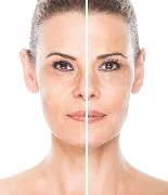 Praxis für med. Kosmetik | Diana Larisch | Kosmetik | Haarentfernung | Naturheilkunde | München - Fadenlifting-VorherNachher | Praxis für med. Kosmetik | Diana Larisch |München