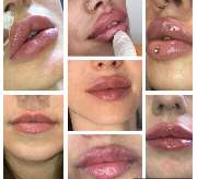 PrettyDoc Düsseldorf - Hyaluron und Botox Düsseldorf - GALLERY