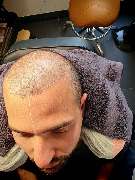 Roberto Haar-Mikropigmentation - GALLERY