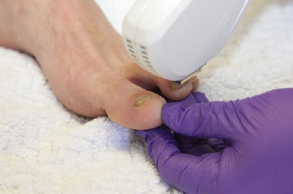 SAMT UND SEIDE - Nagelpilz