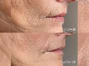 Sara Pavo Cosmetics - Dein Kosmetikstudio in Oberhausen - Sara_pavo_cosmetics_essen_Needling_microNeedling.jpg